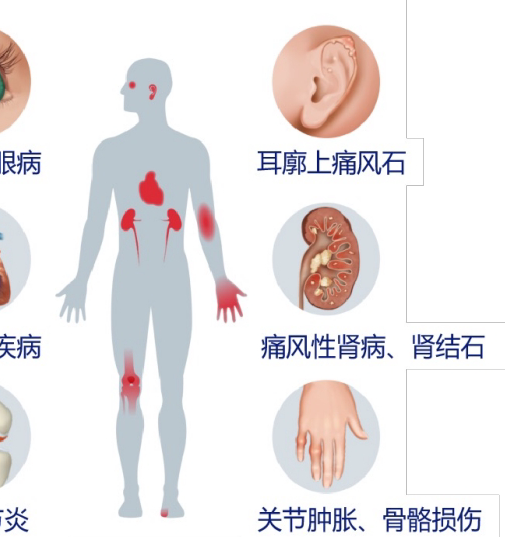 医生强调：药效最强的痛风药，未必对你最“管